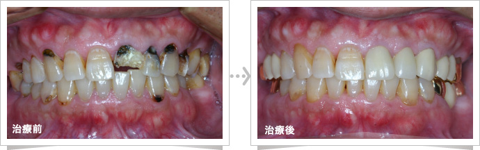 治療前の歯、治療後の歯