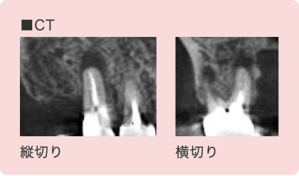 CT画像