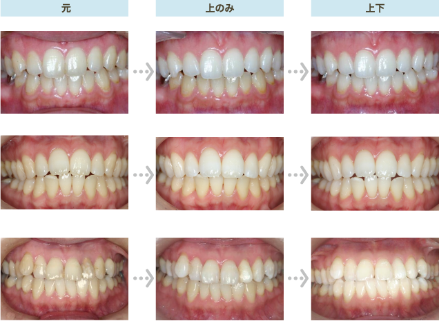 ホワイトニング治療例